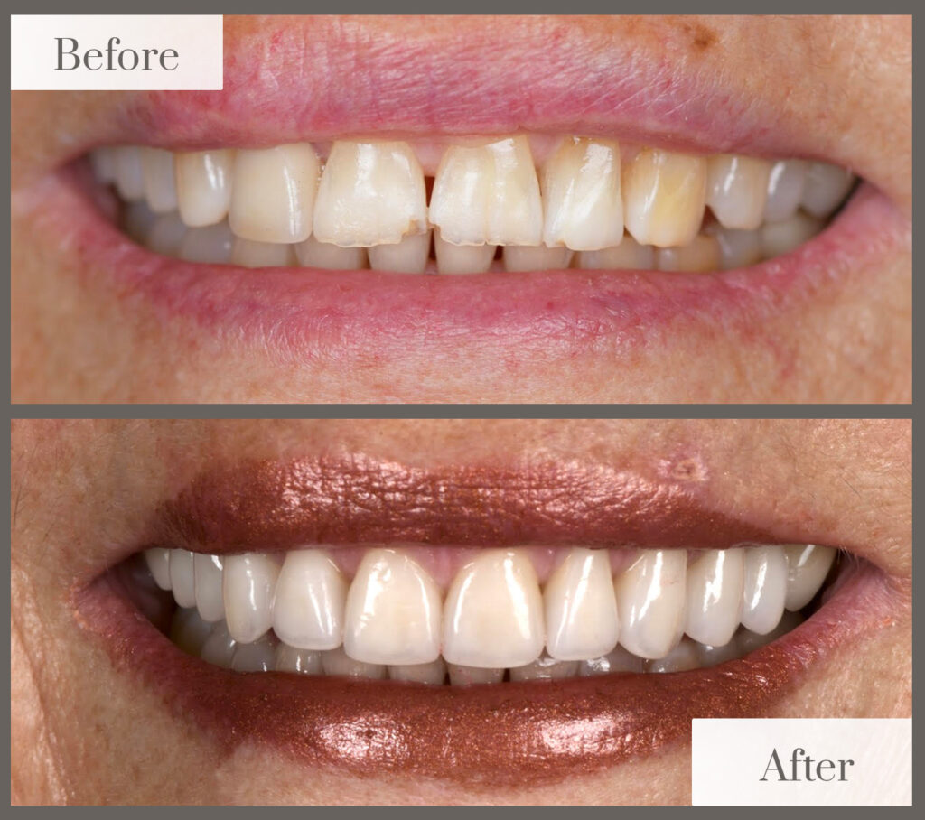 Before and after photos of a patient’s smile: worn, uneven, discolored teeth before; even, bright teeth after