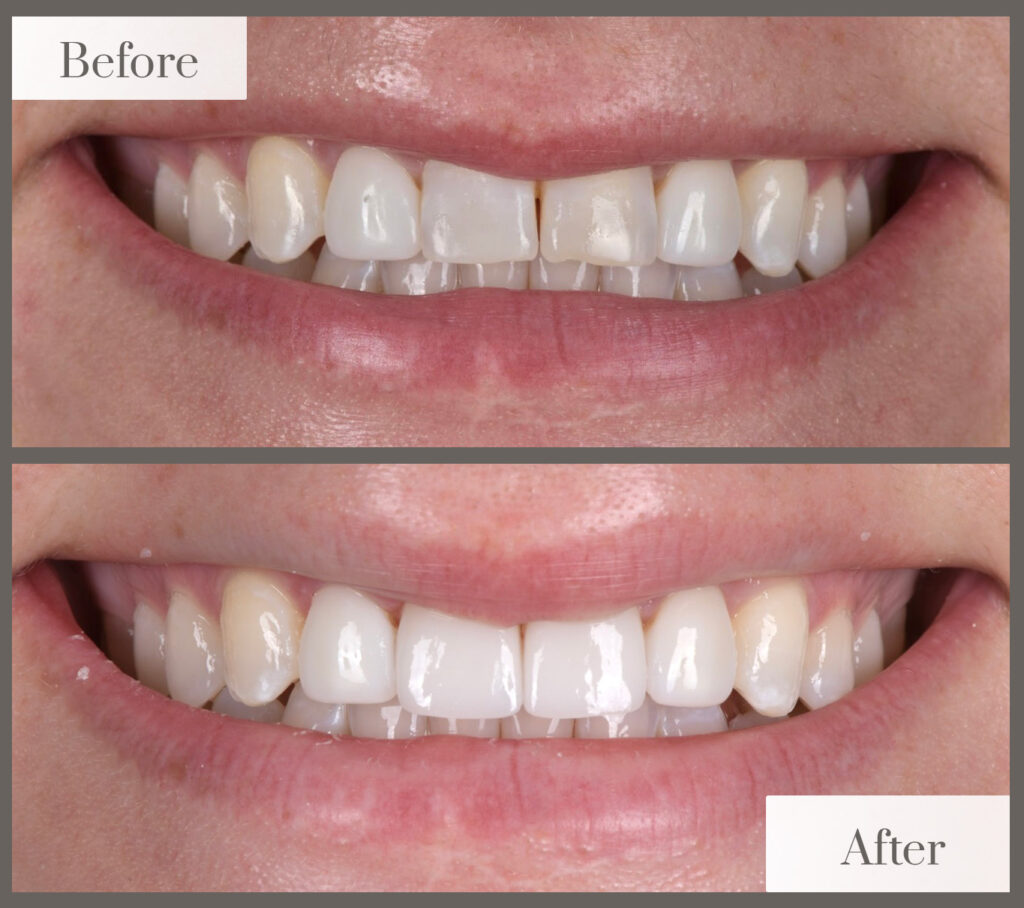 Before and after photos of a patient’s smile: uneven, slightly crowded front teeth before; even, whiter teeth after