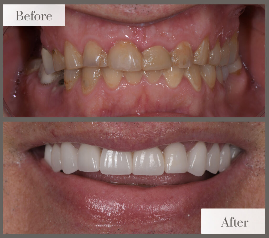 Before and after photos of a patient’s smile: worn, stained teeth before; full, even, white teeth after